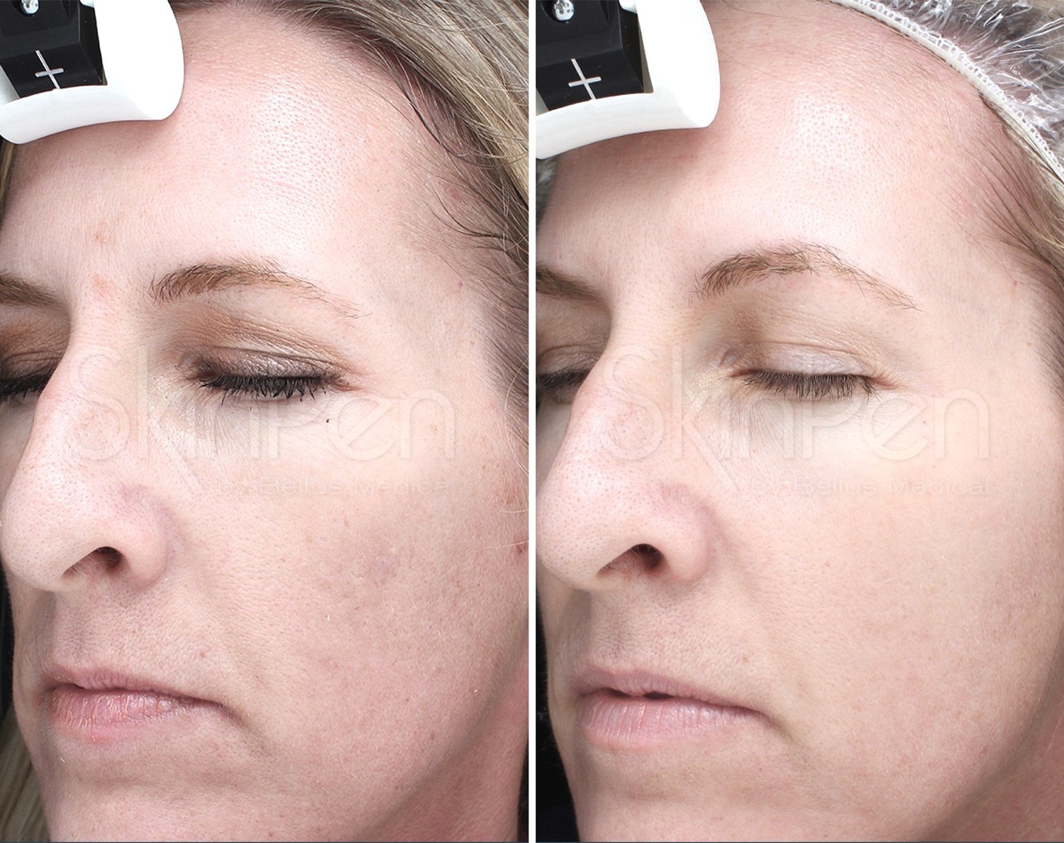 Microneedling London Before and After
